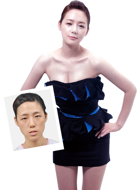 韓國(guó)灰姑娘整形外科真實(shí)整形日記